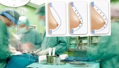 How breast lipilification is performed