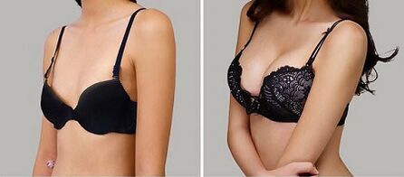 Photo before and after increasing breast