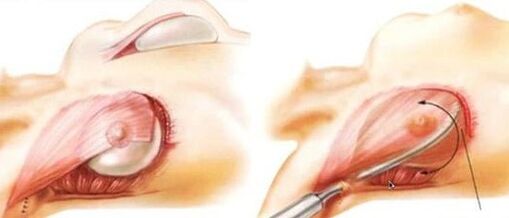 How the breast increase operation is performed