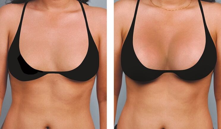 photo before and after breast enlargement