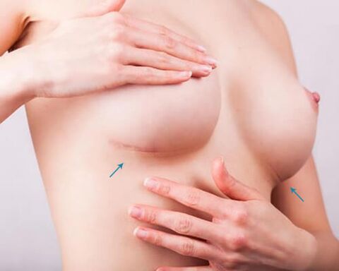 Breast enlargement with plants