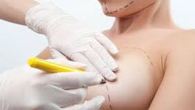 Breast increase surgery