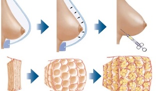 how the breast augmentation procedure is performed with fat