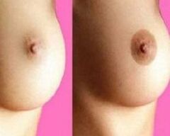before and after nipple enlargement